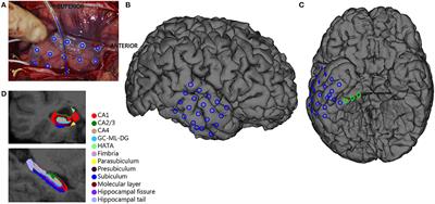 Are HFOs in the Intra-operative ECoG Related to Hippocampal Sclerosis, Volume and IQ?